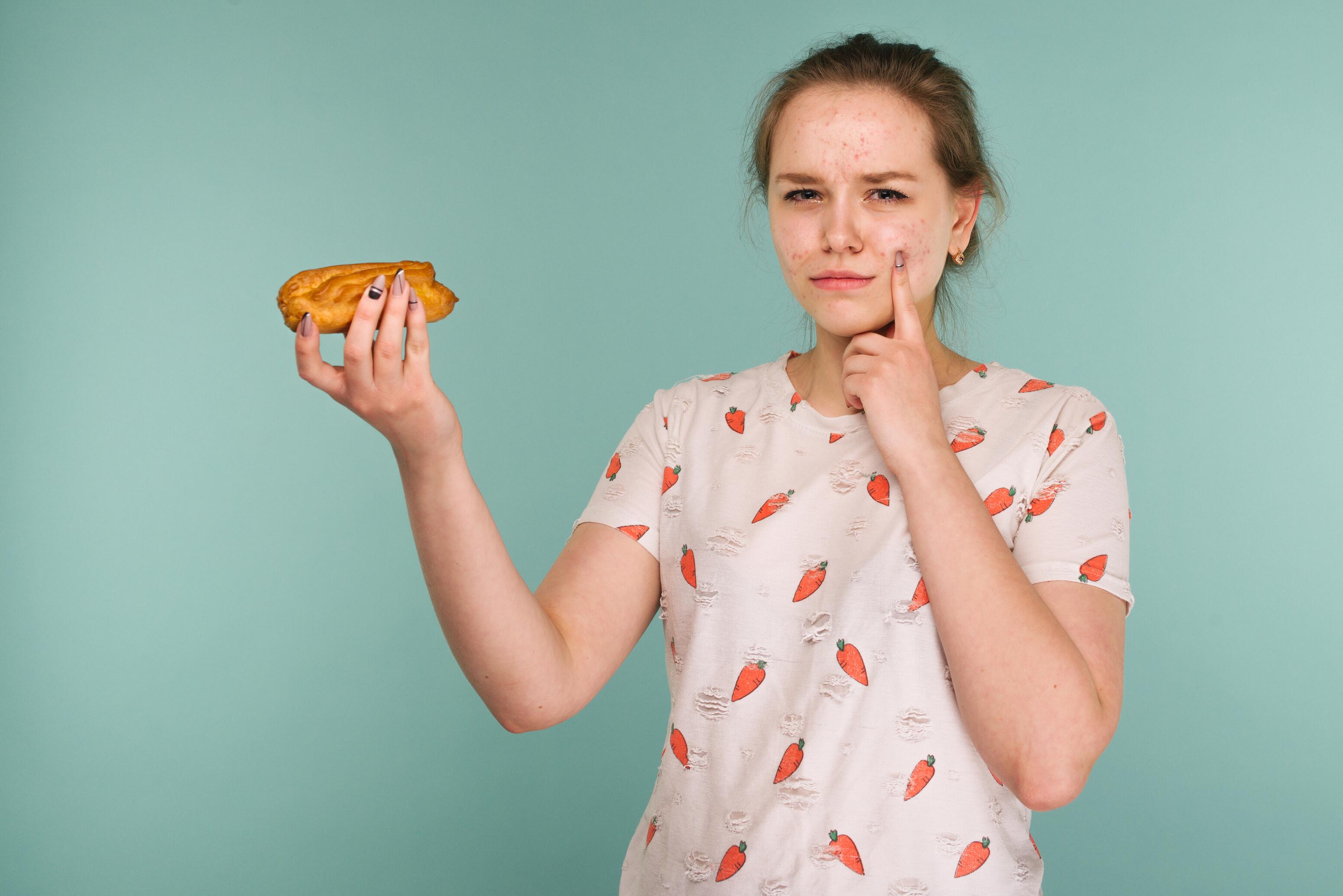 Acné y alimentación